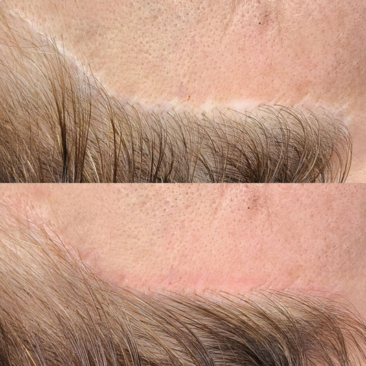 FORMAÇÃO MICROPIGMENTAÇÃO PARAMÉDICA - CAMUFLAGEM DE CICATRIZES