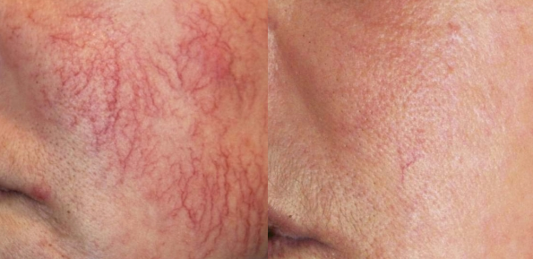 LASER VASCULAR PARA DERRAMES