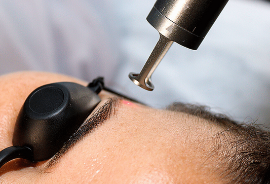 LASER REMOÇÃO MICROPIGMENTAÇÃO