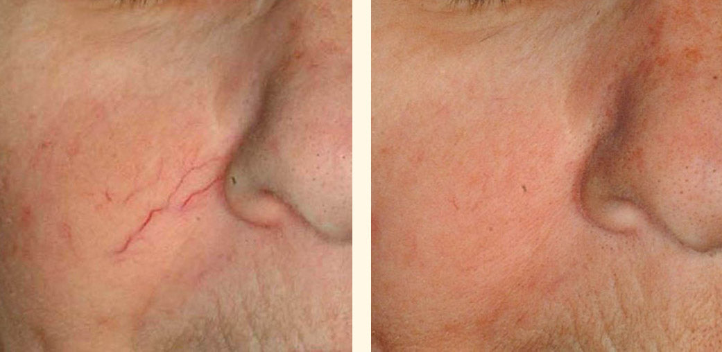 LASER VASCULAR PARA DERRAMES