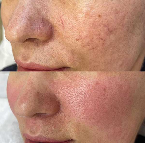 LASER VASCULAR PARA DERRAMES