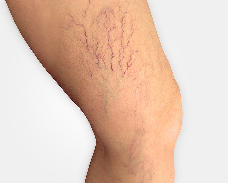 LASER VASCULAR PARA DERRAMES
