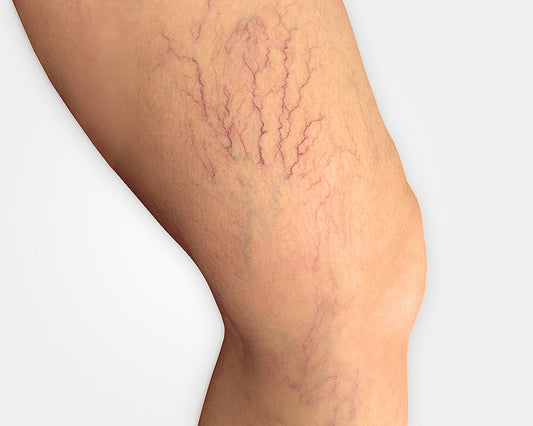 LASER VASCULAR PARA DERRAMES