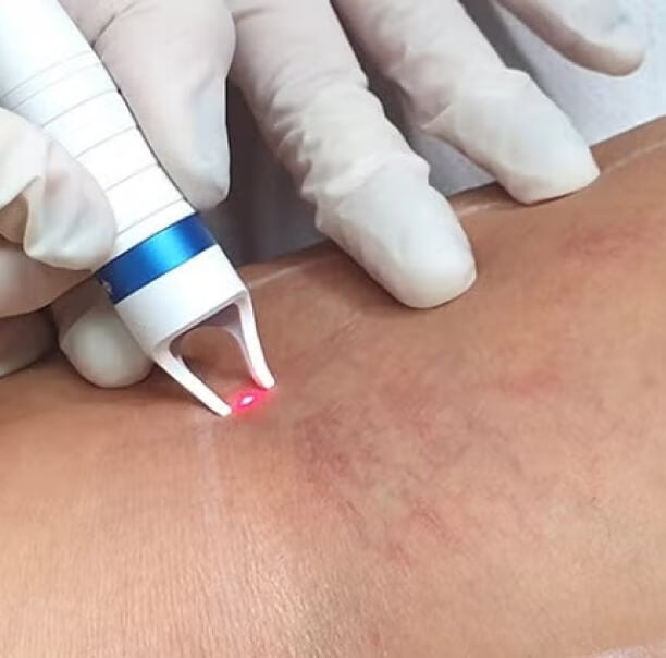 LASER VASCULAR PARA DERRAMES