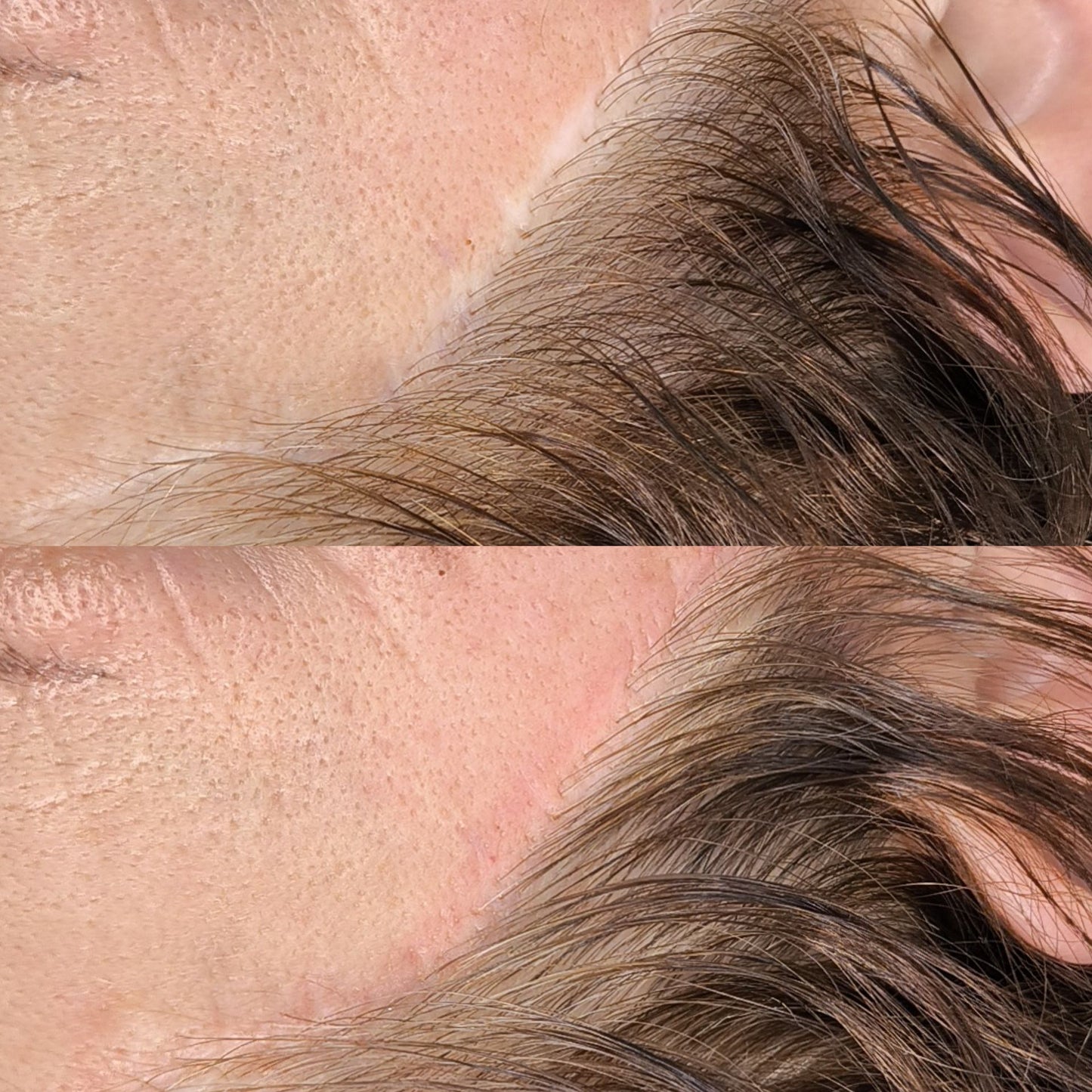 FORMAÇÃO MICROPIGMENTAÇÃO PARAMÉDICA - CAMUFLAGEM DE CICATRIZES